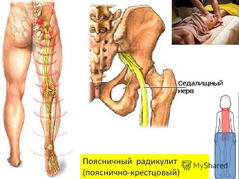 Анатомия седалищного нерва у человека расположение фото