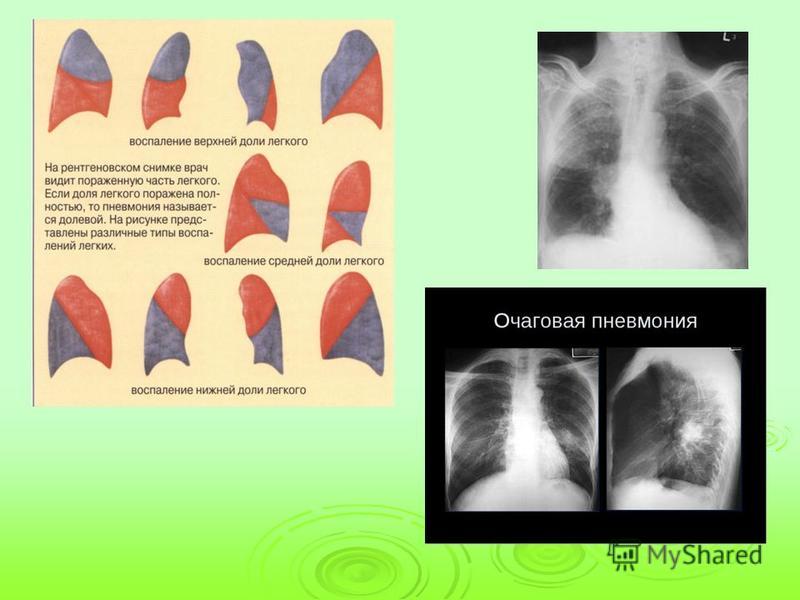 Левосторонняя нижнедолевая пневмония у взрослых