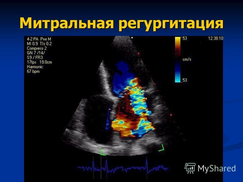 Что такое митральная регургитация