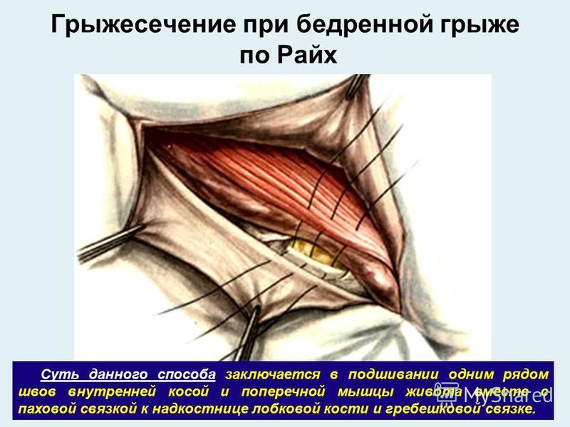 Бассини при бедренной грыже. Герниотомия бедренной грыжи. Грыжесечение паховой грыжи. Бассини бедренная грыжа. Операция грыжесечения.