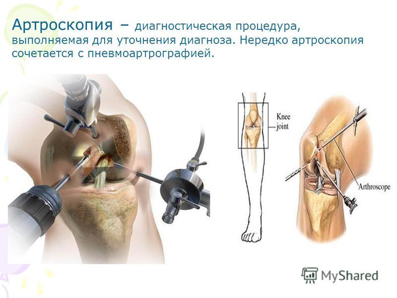 Операция по восстановлению коленного сустава