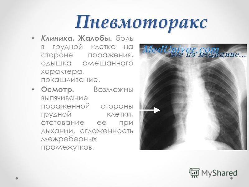 Симптомы пневмоторакса у взрослых