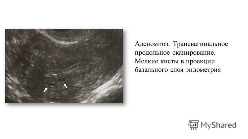 Причины возникновения эндометрии. Трансвагинальное УЗИ полип эндометрия. Базальный слой эндометрия.