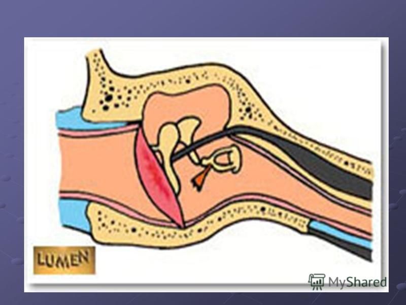 Заложенность уха тубоотит. Катаральное воспаление среднего уха. Заболевания среднего уха Катар. Хронический слипчивый Катар среднего уха.