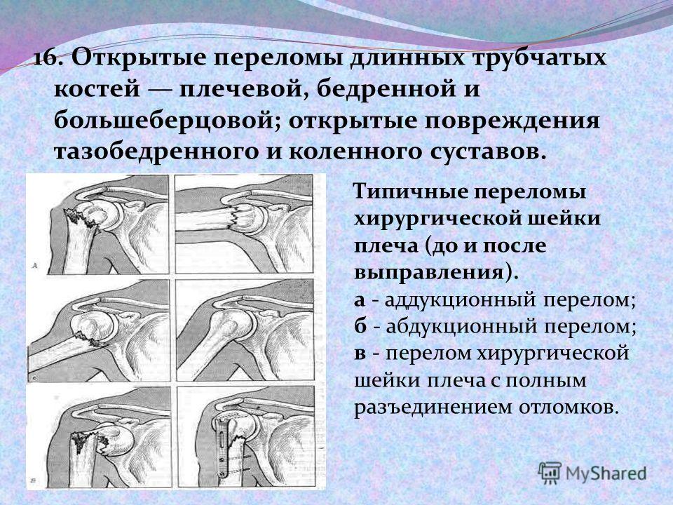 Перелом хирургической шейки плечевой кости рентген классификация. Переломы хирургической шейки плеча репозиция. Прогнозы после операции перелома шейки