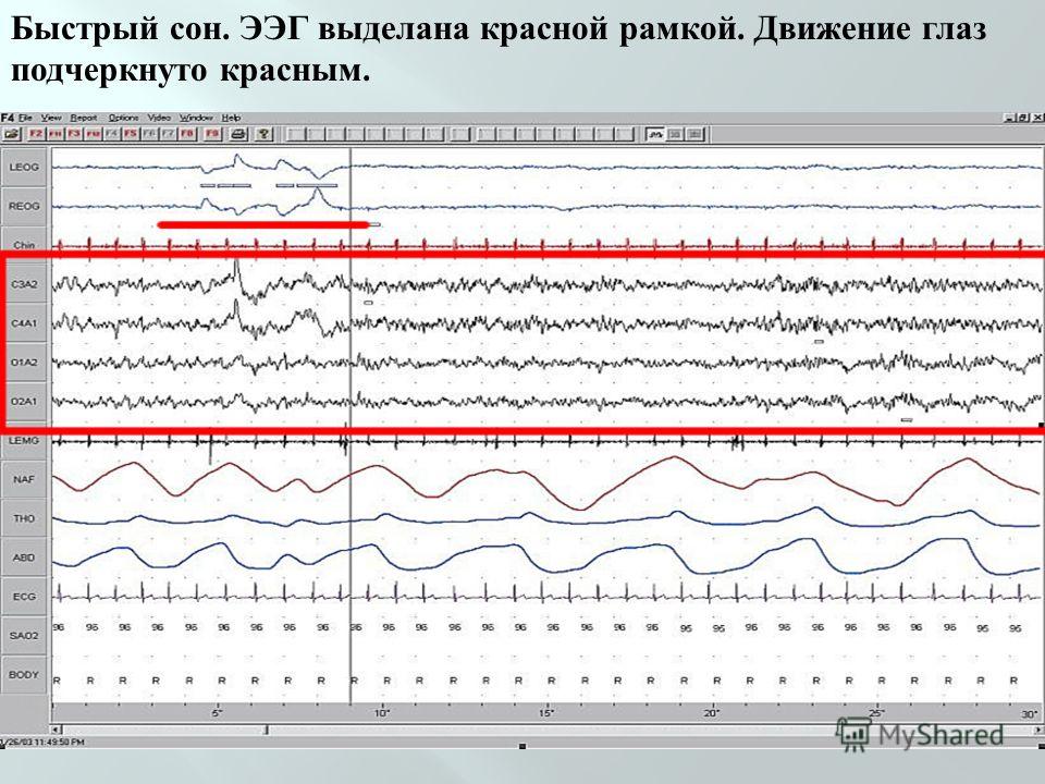 Ночной мониторинг ээг. Быстрый сон. ЭЭГ движения глаз. ЭЭГ сна. ЭЭГ сигнал.