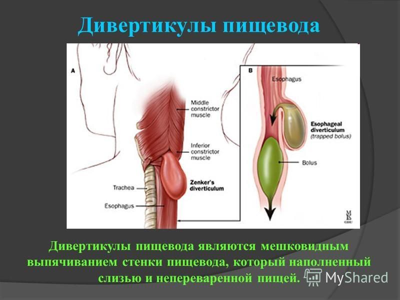 Дивертикул пищевода операция