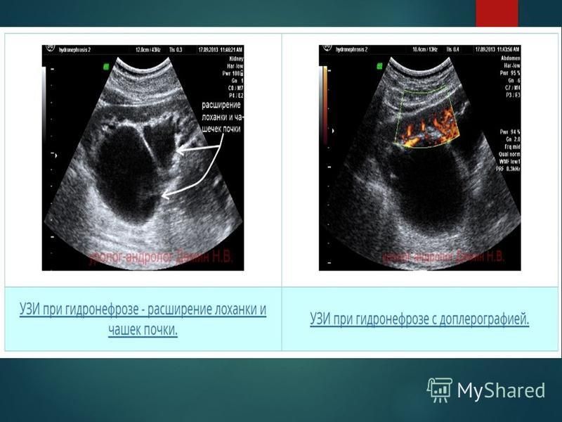 Узи в отрадном москва. УЗИ почек гидронефроз 1ст.