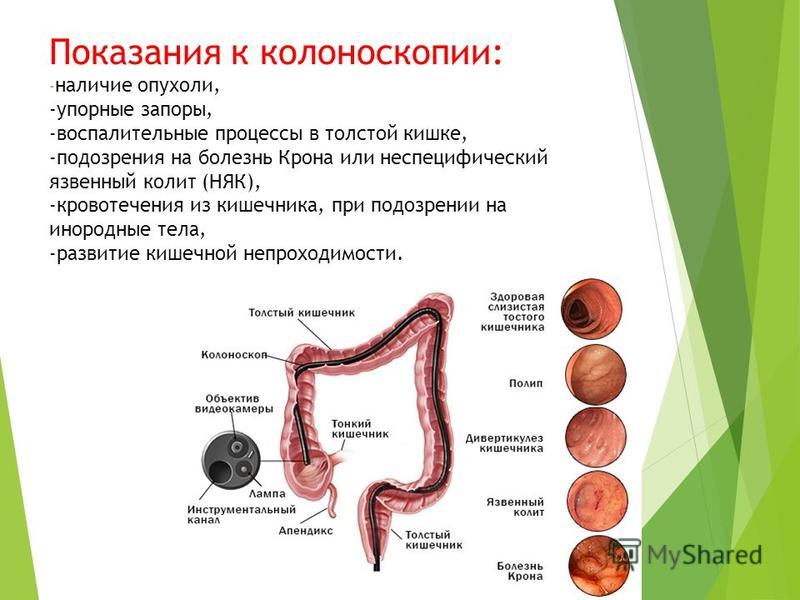 Виртуальная колоноскопия кишечника