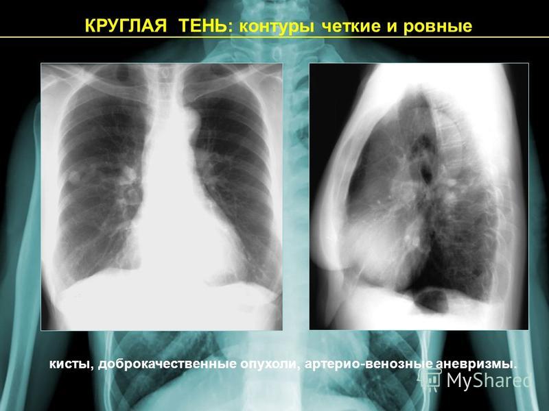 Доброкачественные опухоли легких презентация