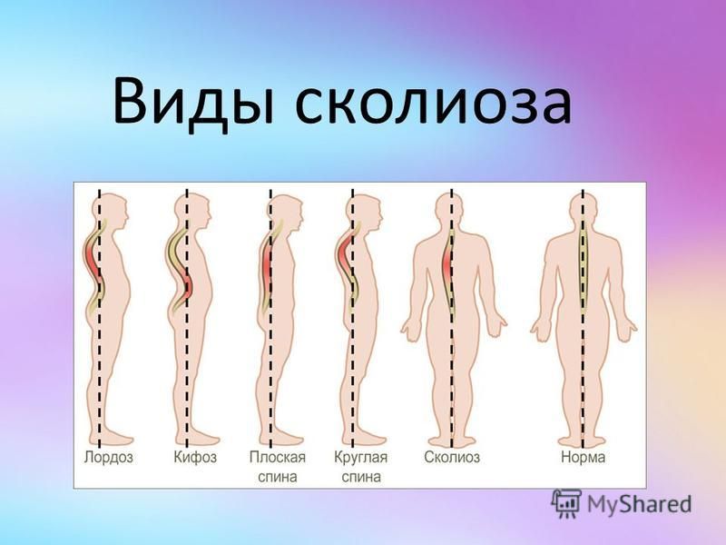 Виды позвоночника