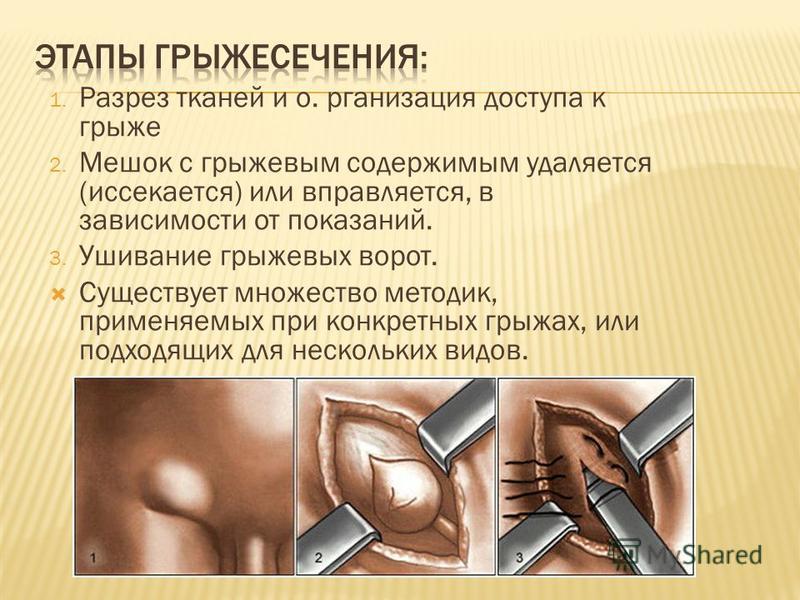 Ущемленная вентральная грыжа карта вызова скорой медицинской