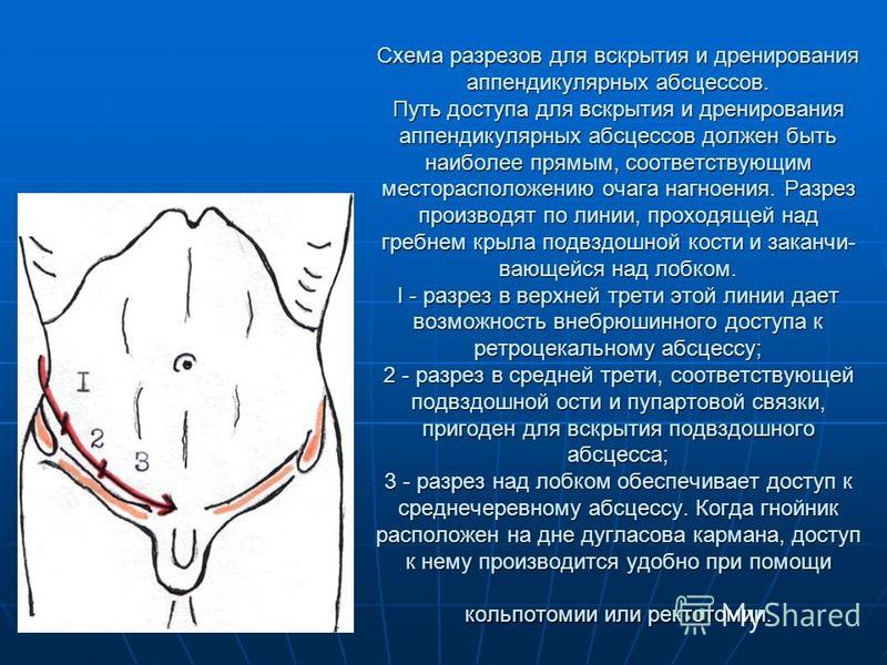 Абсцесс после аппендэктомии