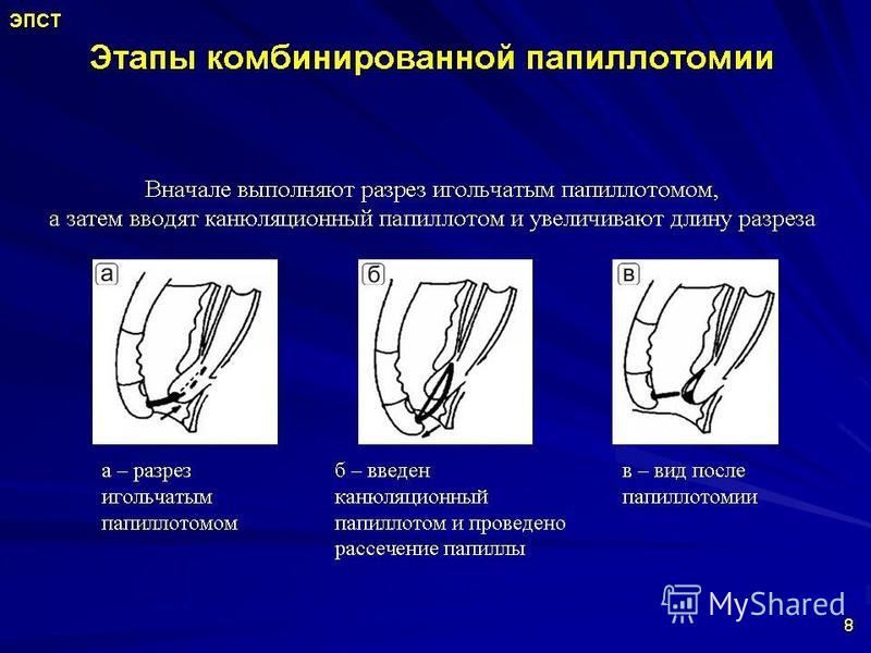 Эндоскопическая папиллосфинктеротомия презентация