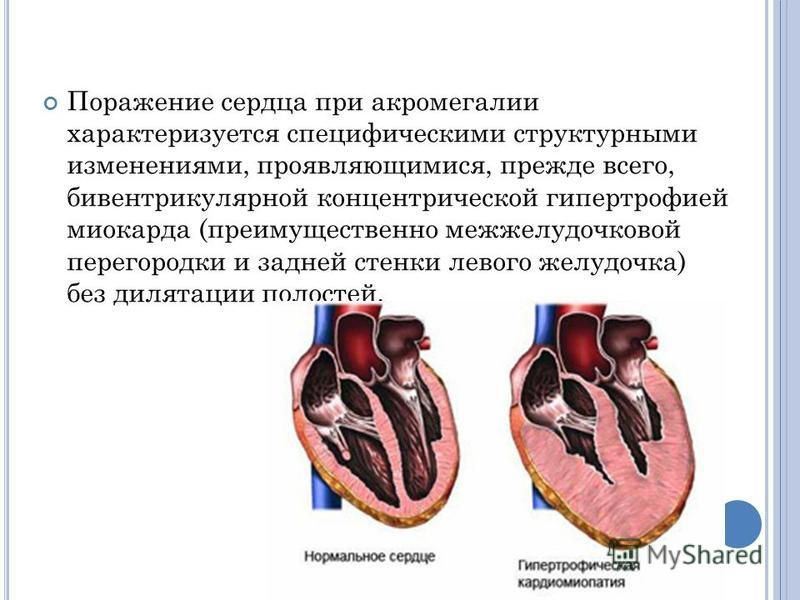 Увеличение сердца симптомы