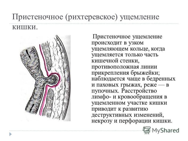 Наружные и внутренние грыжи живота презентация