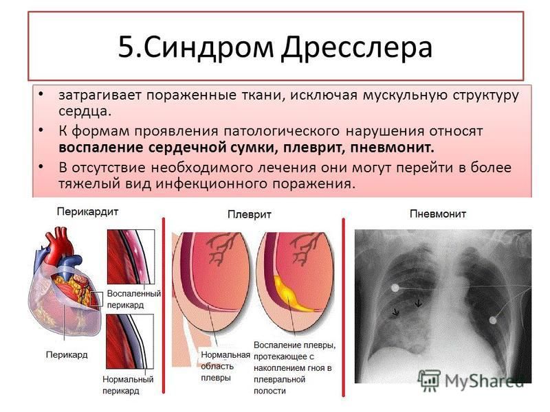 Синдром дресслера фото