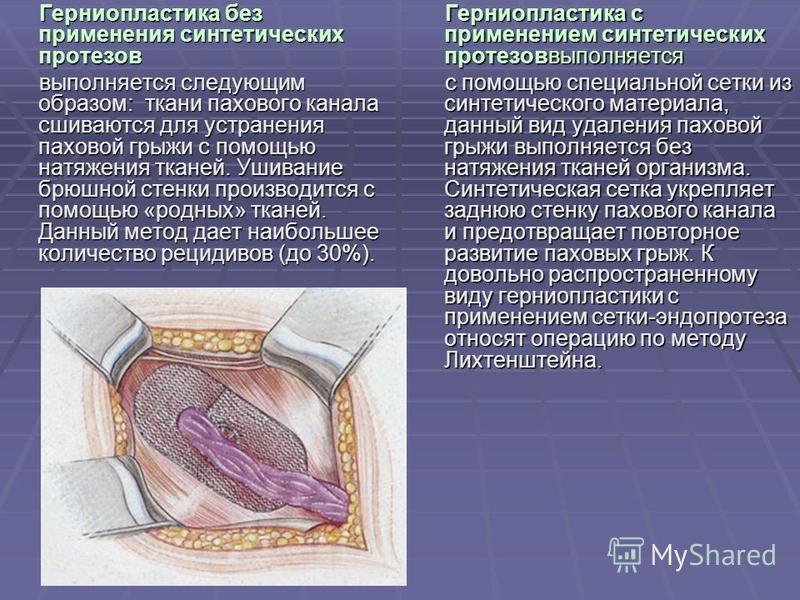 Паховая грыжа отзывы. Герниопластика паховых грыж. Герниопластика без натяжения тканей.