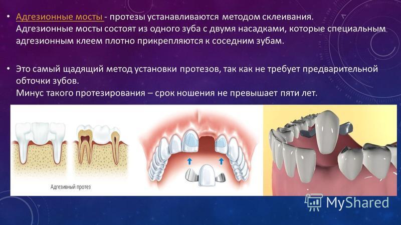 Адгезивный мостовидный протез что это такое фото