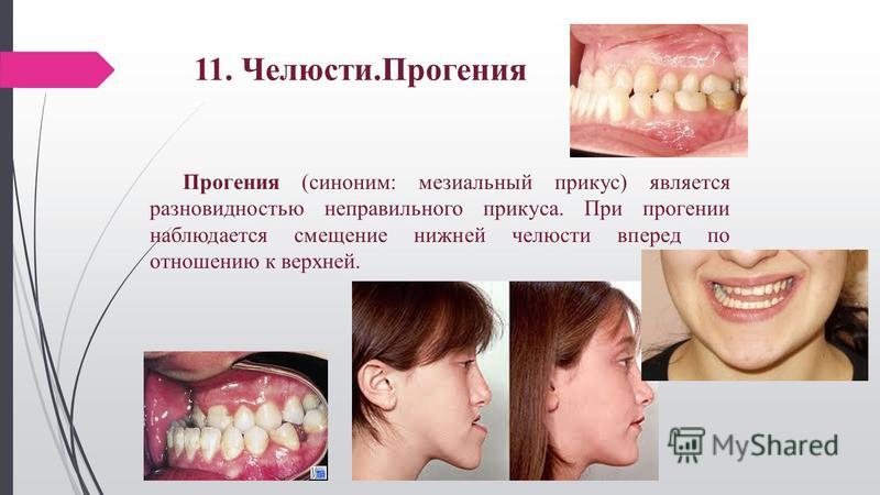 Мезиальный прикус презентация