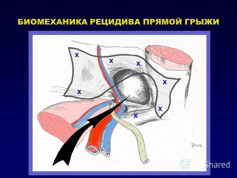 Какую стенку бедренного кольца рассекают при ущемленной бедренной грыже