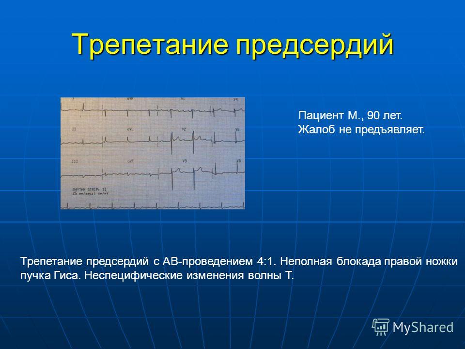 Трепетание предсердий. Трепетание предсердий 2:1. Трепетание предсердий с проведением 2 1. Трепетание предсердий с АВ проведением.