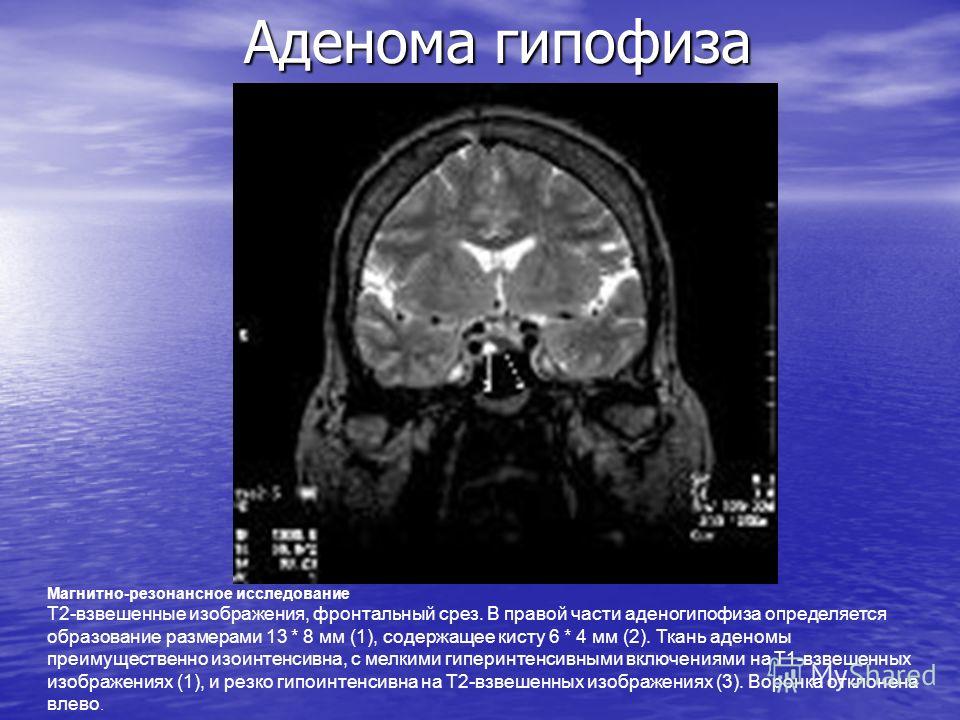 Микроаденома гипофиза