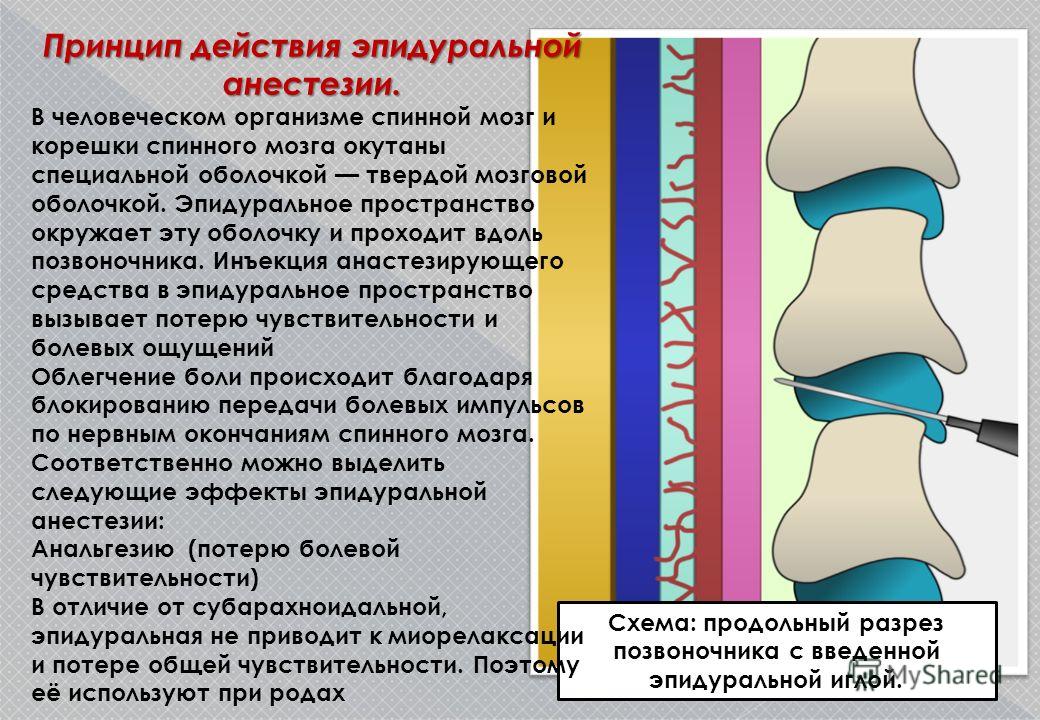 Анестезия при грыже позвоночника. Спинальная и эпидуральная анестезия. Последствия эпидуральной эпидуральная анестезия. Спинальная и эпидуральная анестезия отличия. Болит спина после эпидуральной анестезии.