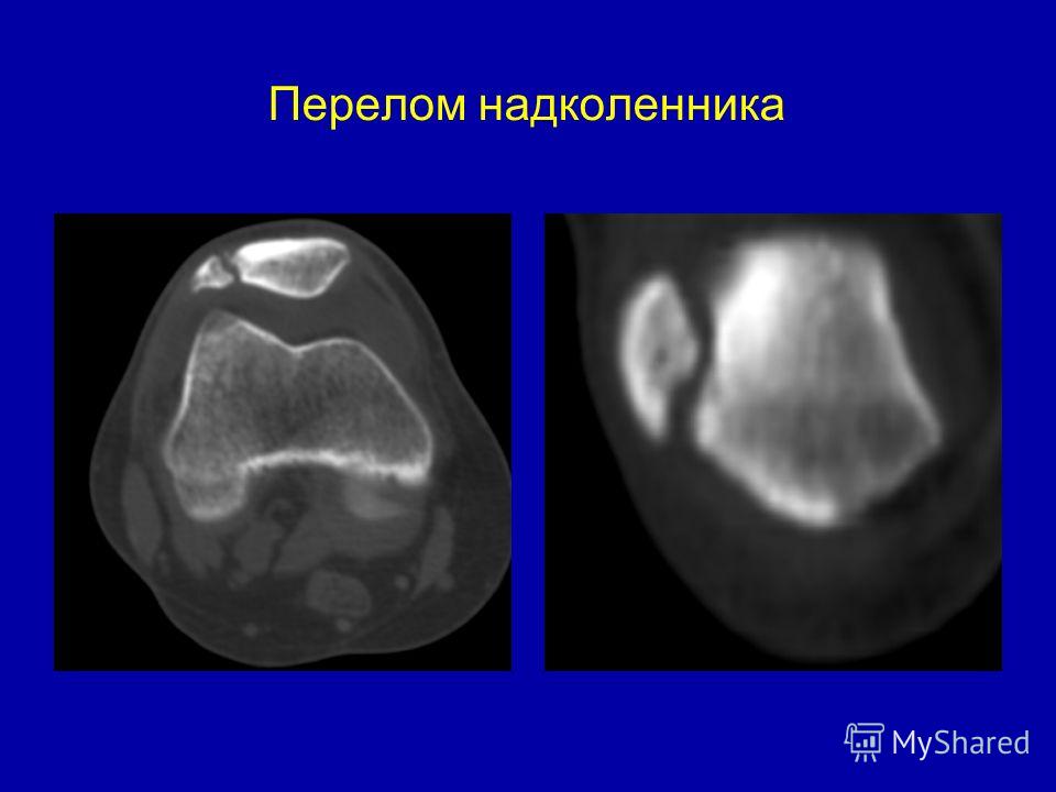 Перелом надколенника сроки. Краевой перелом верхушки надколенника. Закрытый краевой перелом надколенника. Многооскольчатый перелом надколенника. Переломы надколенника классификация рентген.