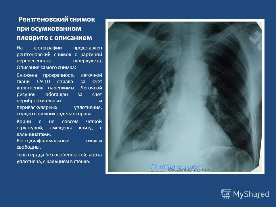 Описание рентген снимка. Фибринозный плеврит рентген. Пневмония с плевритом рентген. Туберкулез плеврит рентген. Плеврит на рентгене описание снимка.