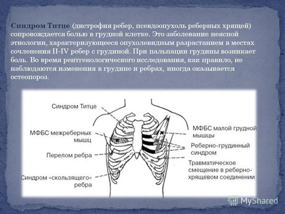 Синдром титце фото