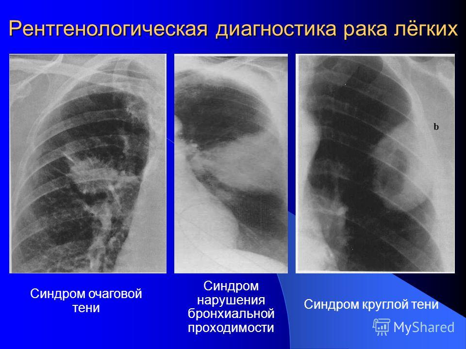 Рентген центр. Шаровидная пневмония рентген. Долевая пневмония рентген. Опухоль в легких на рентгене. РВК легкого на рентгене.