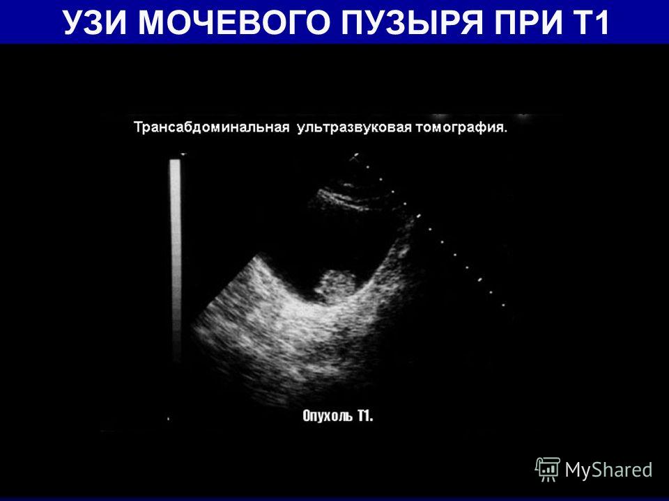 Алгоритм подготовки пациента к узи мочевого пузыря