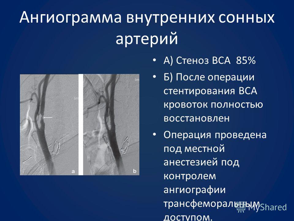 Атеросклероз стенозирующий брахиоцефальных артерий отделов брахиоцефальных