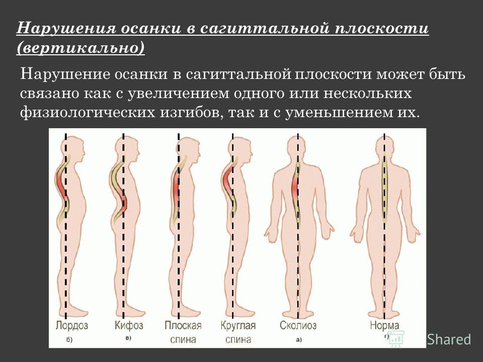 Главная причина нарушения осанки