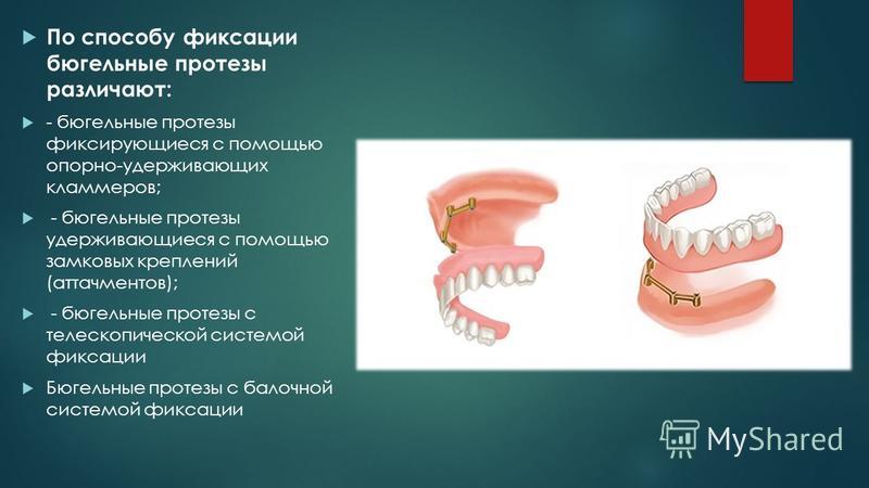 Фиксация съемного протеза