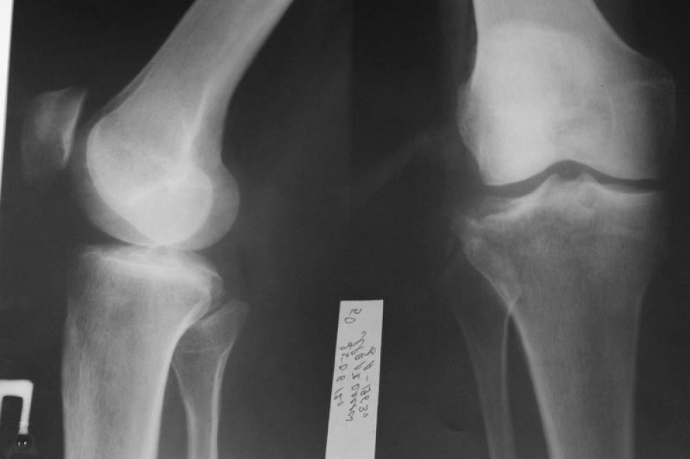 Мыщелок фото. Перелом мыщелка коленного сустава рентген. Перелом мыщелка локтевого сустава. Перелом в колене мыщелка. Перелом мыщелка большеберцовой кости.