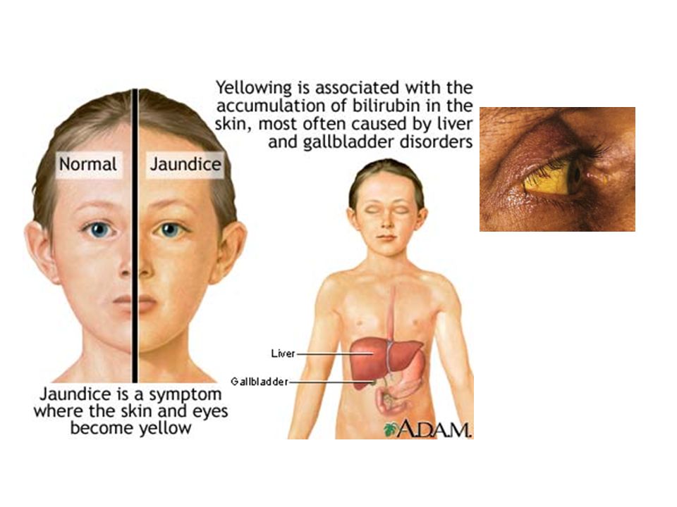 Желтух инфекционные болезни. Симптомы и проявления желтухи у детей. Желтушный синдром у детей.