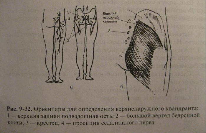 Место для укола в бедро на схеме