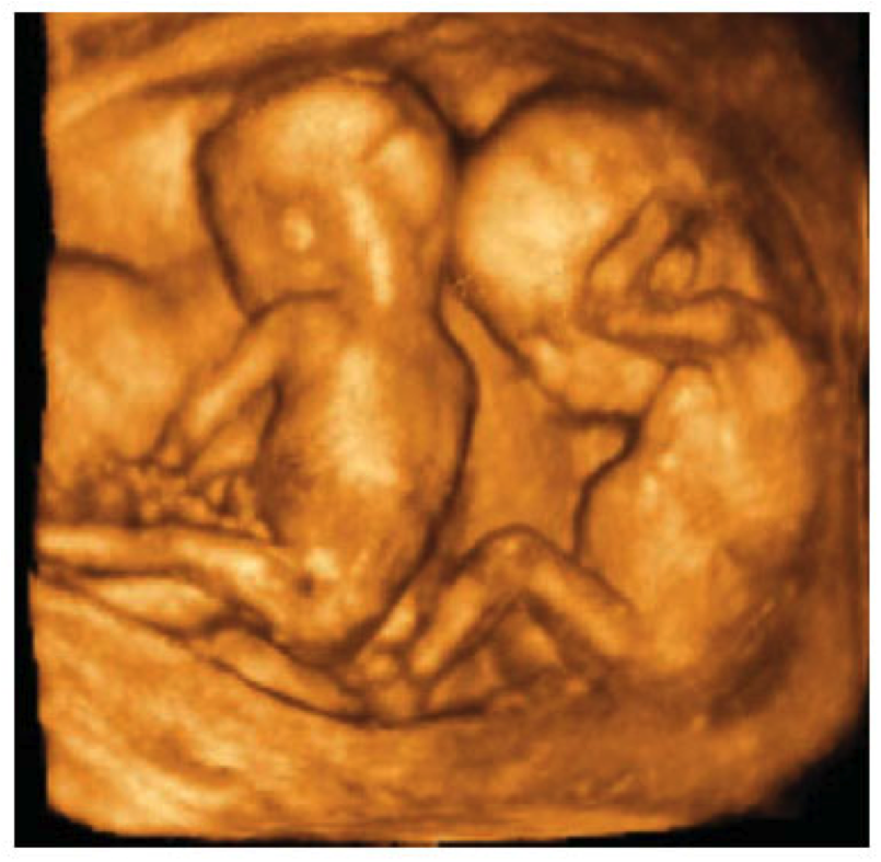 23 недели двойня. УЗИ беременности 3д многоплодная. Монохориальная двойня УЗИ. 4 Д УЗИ на 13 неделе беременности.