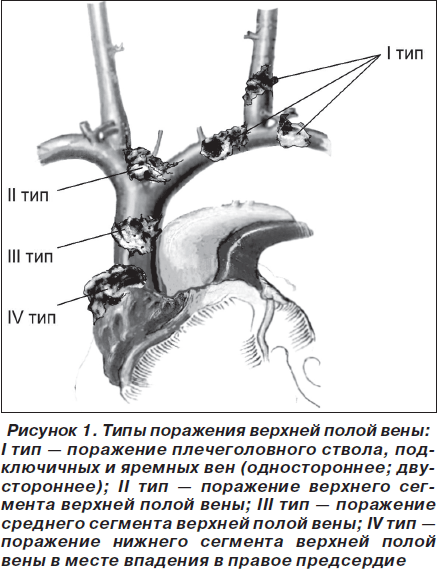 Рисунки верхней полой. Синдром верхней полой вены. Синдром сдавливания верхней полой вены. Обструкция верхней полой вены. Тромбоз верхней полой вены.