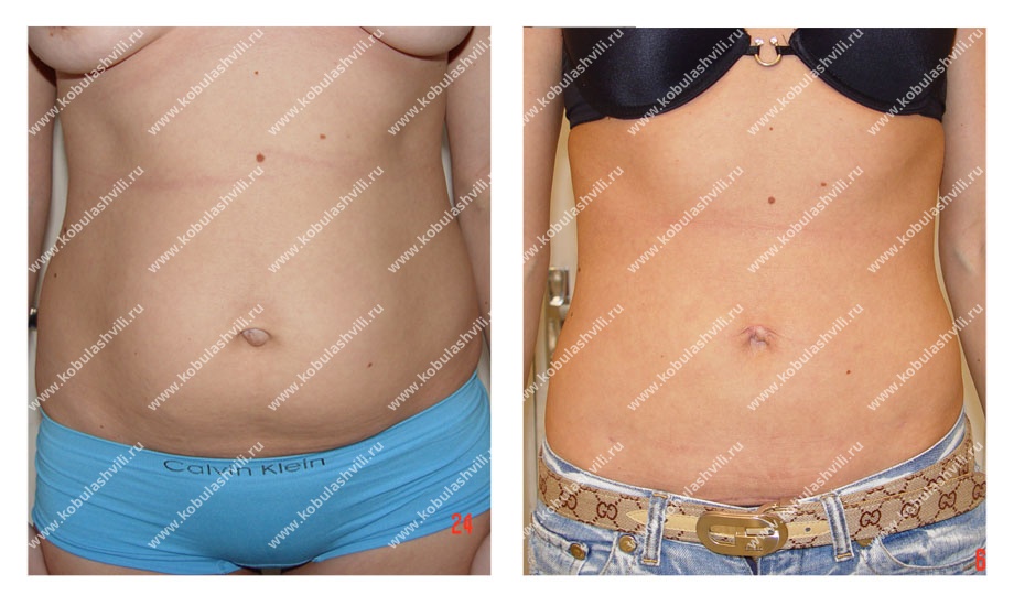 Подтяжка груди фото до и после операции