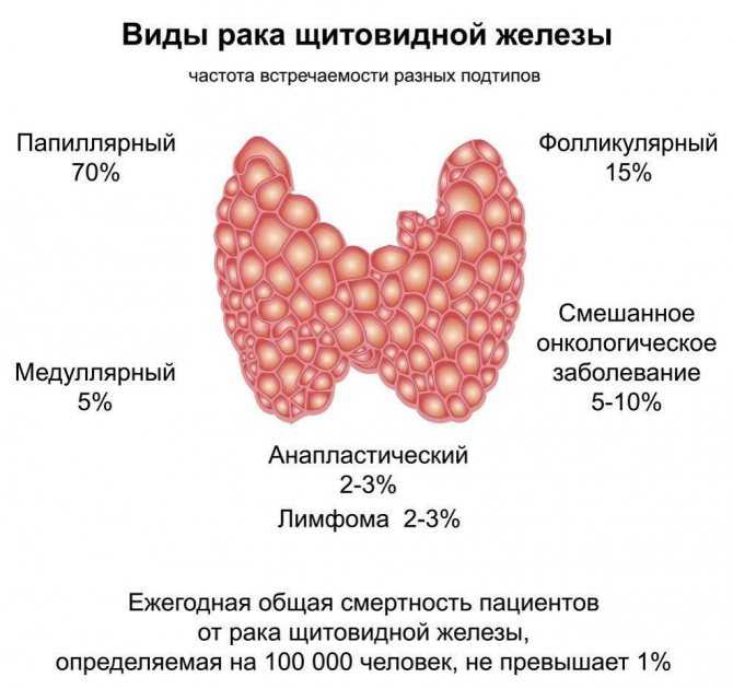 Опухоль железы на латинском