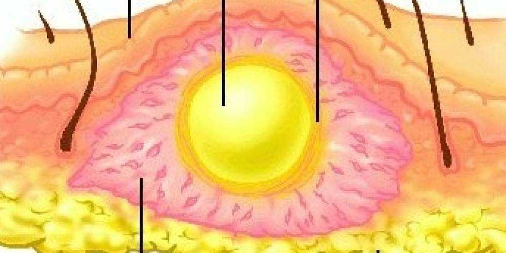 Воспалительный инфильтрат. Фурункул карбункул флегмона. Фурункул абсцесс флегмона. Пилонидальный фурункул. Что такое абсцесс кожи с карбункулом.