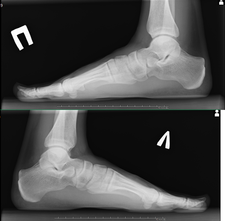 Рентген стопы в двух проекциях фото с описанием