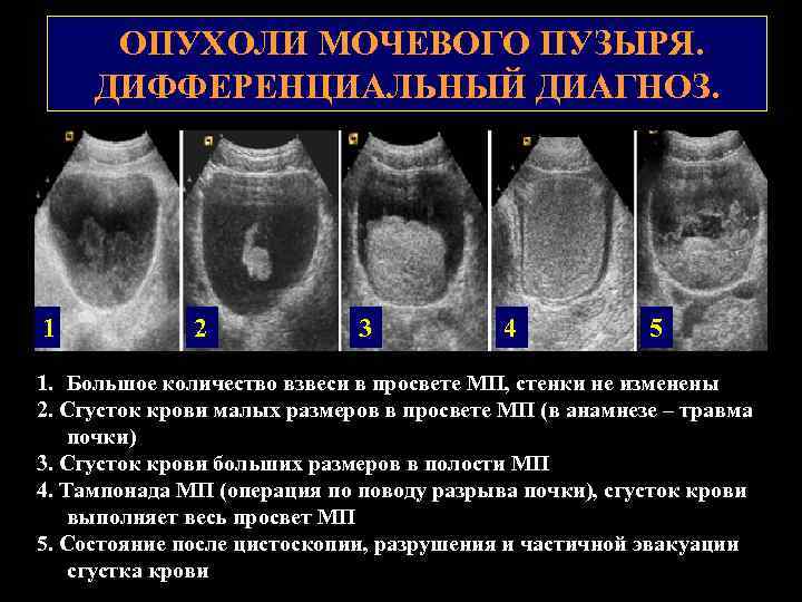 Рак мочевого пузыря у женщин