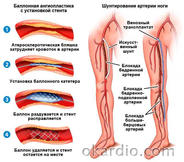 Операция на артерии нижних конечностей. Шунтирование атеросклероза. Баллонная ангиопластика артерий нижних конечностей ход операции. Шунт артерии нижних конечностей. Атеросклероз артерий нижних конечностей (синдром Лериша).