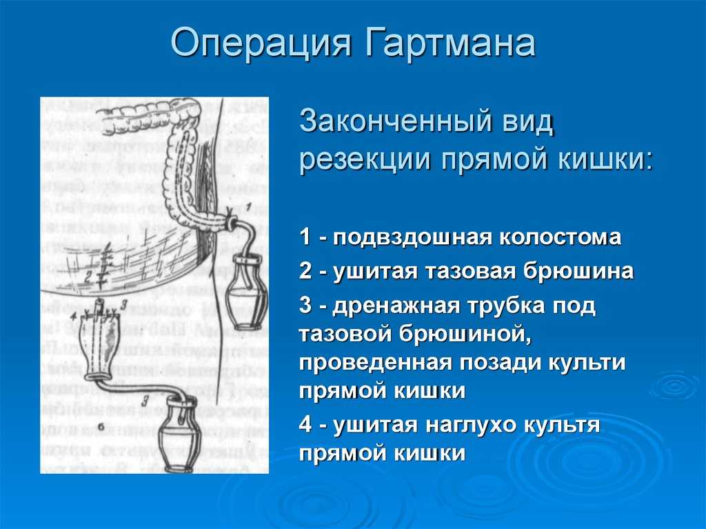 Хирургия прямой кишки. Операция Гартмана на прямой кишке. Одноствольная колостомия операция Гартмана. Колостома операция Гартмана. Одноствольная колостома после операции Гартмана.