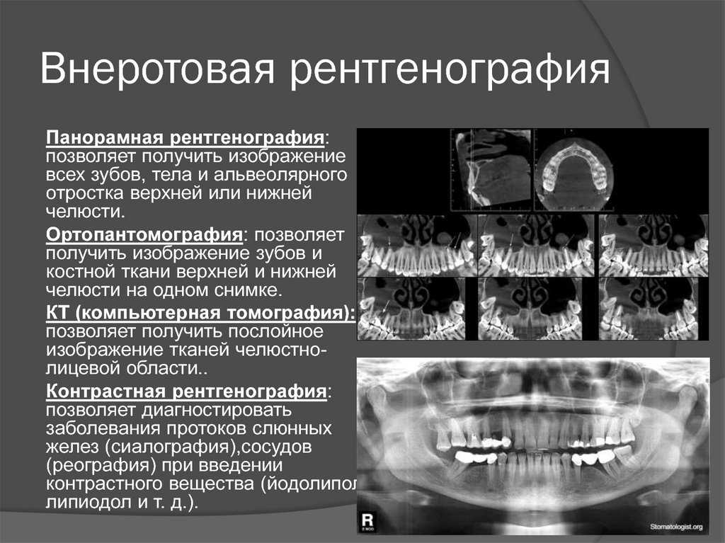 Расшифровка рентгена зубов с примерами и фото