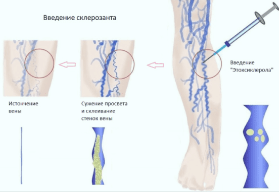 Вены склерозирование. Склеротерапия вен реабилитация. Склеротерапия вен нижних конечностей до и после. Паравазальная склеротерапия. Противопоказанием для склеротерапии варикозно расширенных вен.